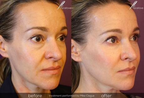 The Easiest Method Of Performing Dermal Filler For Beauty Therapist