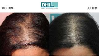 Land at DHI to get the best hair transplant in Jaipur Land at DHI to get the best hair transplant in Jaipur
