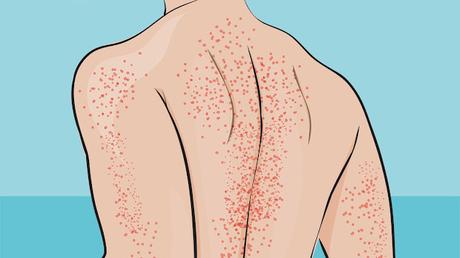 Thrombocytopenia Treatment Market Thrombocytopenia Treatment Market