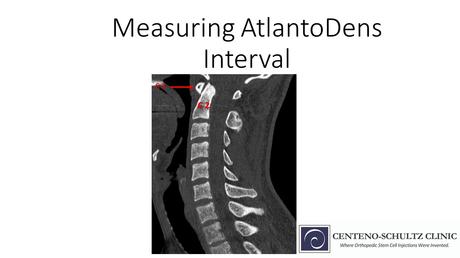 atlantodens interval