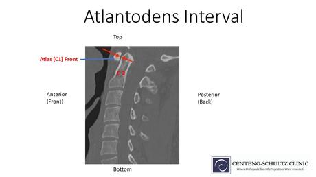 atlantodens interval