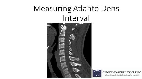 What Is the Atlantodens Interval? A QuickStart Guide