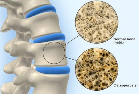 Get answers to some of the most prevalent osteoporosis treatment queries. Bisphosphonates are typically the first line of Osteoporosis Treatment.