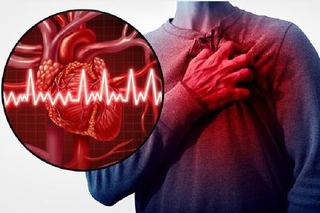 A heart attack medically referred to as a myocardial infarction