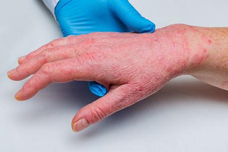 Psoriatic arthritis is a kind of spondyloarthritis that is caused by an inflammatory joint condition caused by psoriasis.