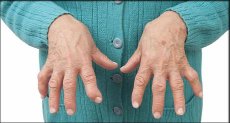 Natural Remedies for The Treatment of Trigger Finger