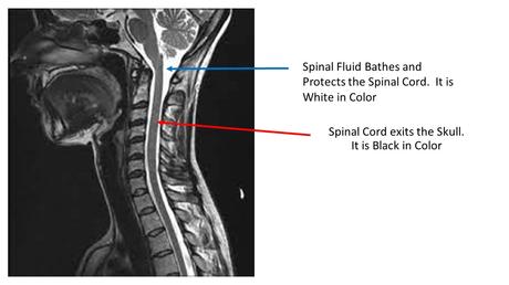 Understanding Cervical Spine Instability Measurements