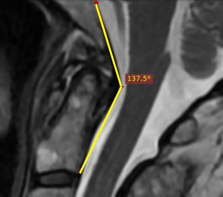 Understanding Cervical Spine Instability Measurements