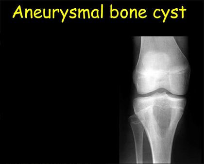 Aneurysmal Bone Cyst And Its Ayurvedic Treatment