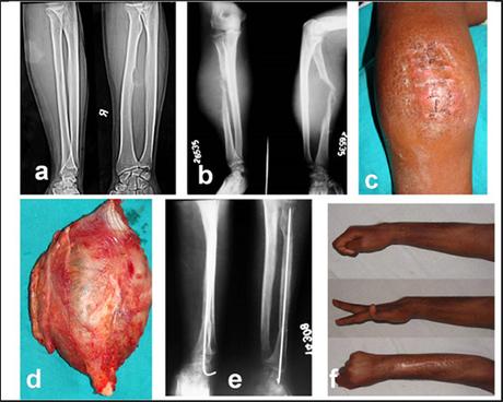 Aneurysmal Bone Cyst And Its Ayurvedic Treatment