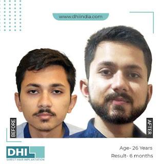 beard transplant in Chennai