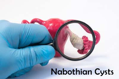 What are some natural remedies to treat Nabothian Cysts?