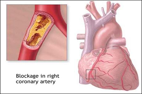 Ayurvedic Treatment For (RCA) Right Coronary Artery Blockage