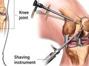 What Knee Arthroscopy Treatment