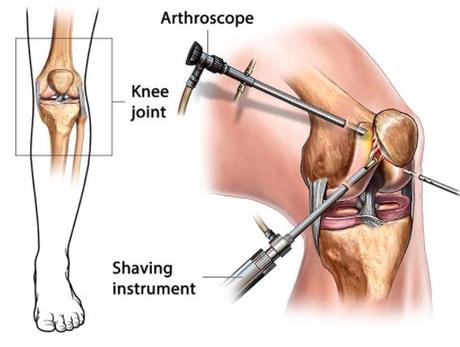 knee arthroscopy surgery in india