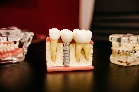 Important Things You Need To Know Before Getting Dental Implants