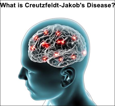 Creutzfeldt-Jakob Disease (CJD) Ayurvedic Treatment!