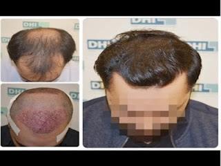 Are you searching for the best hair transplant in Bangalore? DHI has got your needs covered! Are you searching for the best hair transplant in Bangalore? DHI has got your needs covered!