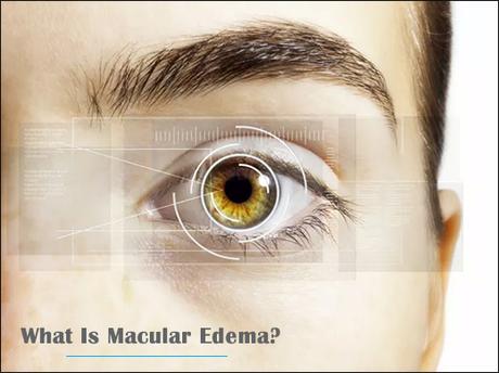 Macular Edema Ayurvedic Treatment With Herbal Remedies!