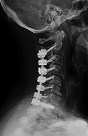 cervical fusion