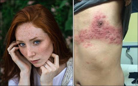 What is SHINGLES (Herpes Zoster)? – Causes, Symptoms and Ayurvedic Treatment