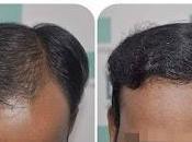 Importance Expert Procedure Hair Transplant Guwahati