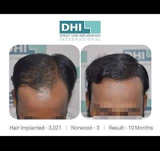 Importance of an expert for the procedure of hair transplant in Guwahati