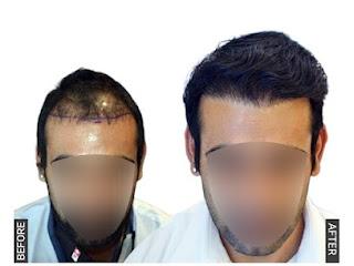 Hair Transplant in Chennai