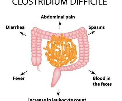 Ayurvedic Treatment For Clostridium Difficile Infection!