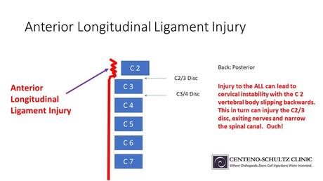 Anterior Longitudinal Ligament: Could This Be Responsible for Your Ongoing Neck Pain?