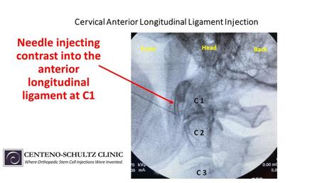 Anterior Longitudinal Ligament: Could This Be Responsible for Your Ongoing Neck Pain?