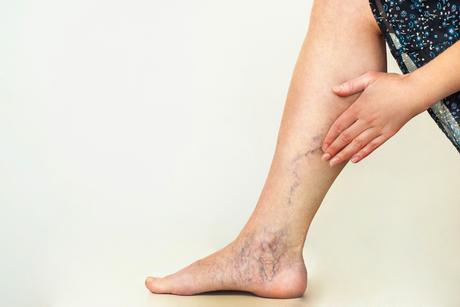 Various Home Remedies For The Varicose Veins