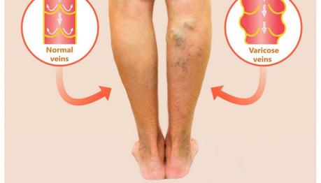 Various Home Remedies For The Varicose Veins