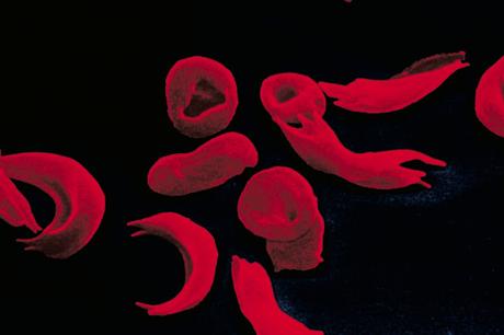 hemoglobinopathy market