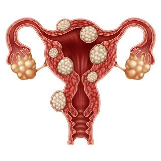 Uterine Fibroid Treatment Devices Market Uterine fibroid embolization (UFE) is a minimally invasive procedure for treating uterine fibroid tumours.