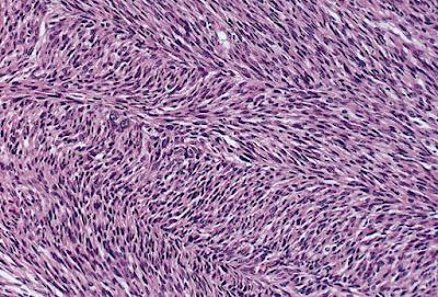 Fibrosarcoma Drugs Market Fibrosarcoma is a rare type of soft tissue malignant tumour made up entirely of fibroblasts, which are fiber-forming connective tissue cells.
