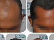 Results 3890 Hair Follicles Implantation India