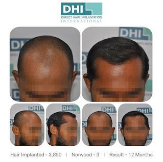 Results of 3890 Hair Follicles Implantation – DHI India