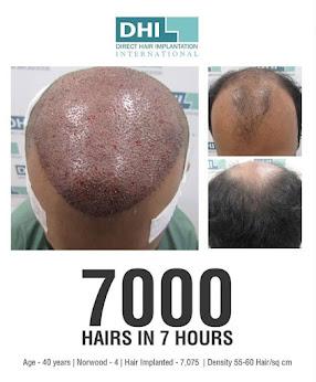 DHI Hair Transplant Results of 7,000 Grafts.