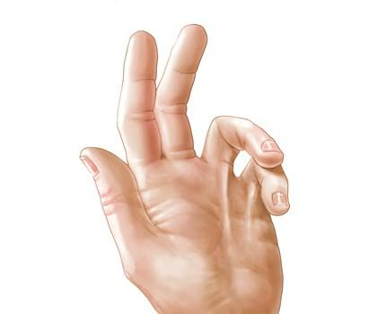 Herbal Remedies For Dupuytren’s Contracture & Treatment