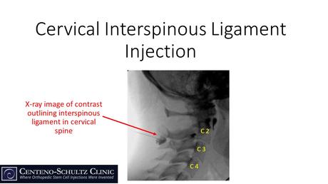 Ligaments of the Spine: Understanding Their Importance