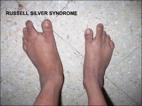 Ayurvedic View On Russell Silver Syndrome & Its Treatment