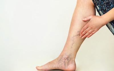 Varicose Vein Treatment Market Varicose veins are dilated, aberrant blood vessels caused by weakened vessel walls. Swollen, twisting clusters of blue or purple veins under the skin appeared to be these veins.