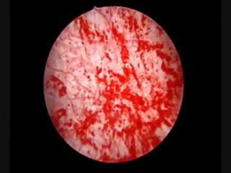 Hunner Ulcers, Symptoms, Causes Diagnosis and Ayurvedic Treatment