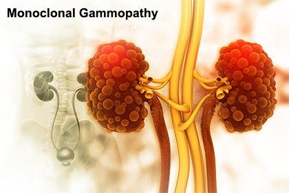 Ayurvedic View On Monoclonal Gammopathy & Its Treatment!