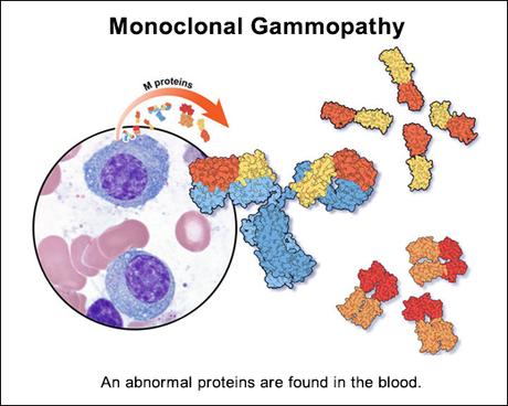 Ayurvedic View On Monoclonal Gammopathy & Its Treatment!