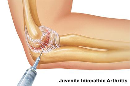 Ayurvedic Treatment For Juvenile Idiopathic Arthritis