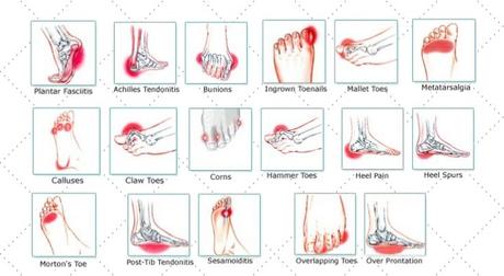 How does Gait Analysis help With Pain–Free Walks?