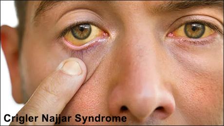 Ayurvedic View On Crigler Najjar Syndrome & Its Treatment