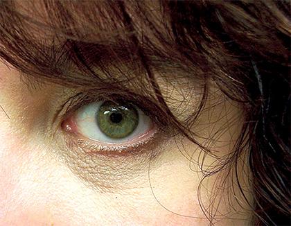 Ayurvedic View On Crigler Najjar Syndrome & Its Treatment